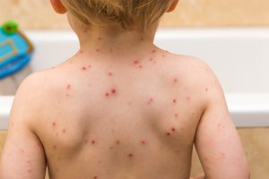 Pox parties were popular for chickenpox